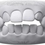 Fix open bite teeth at bespoke dental Fulham with invisalign