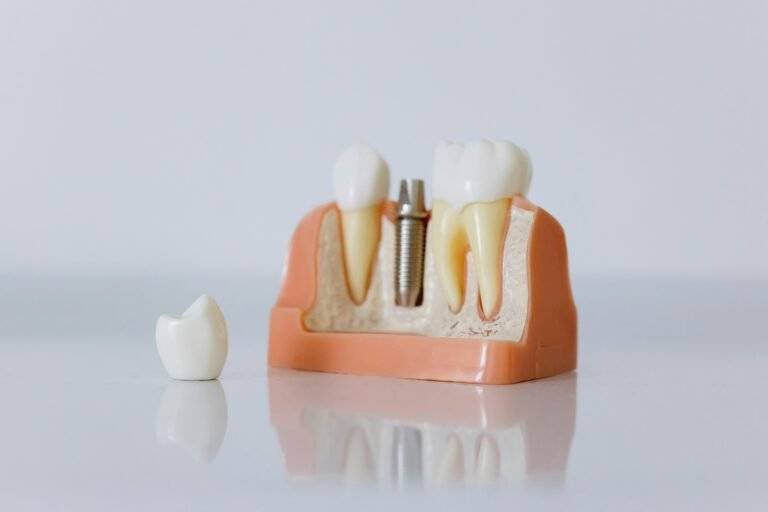 Dental Implants at bespoke dental Fulham