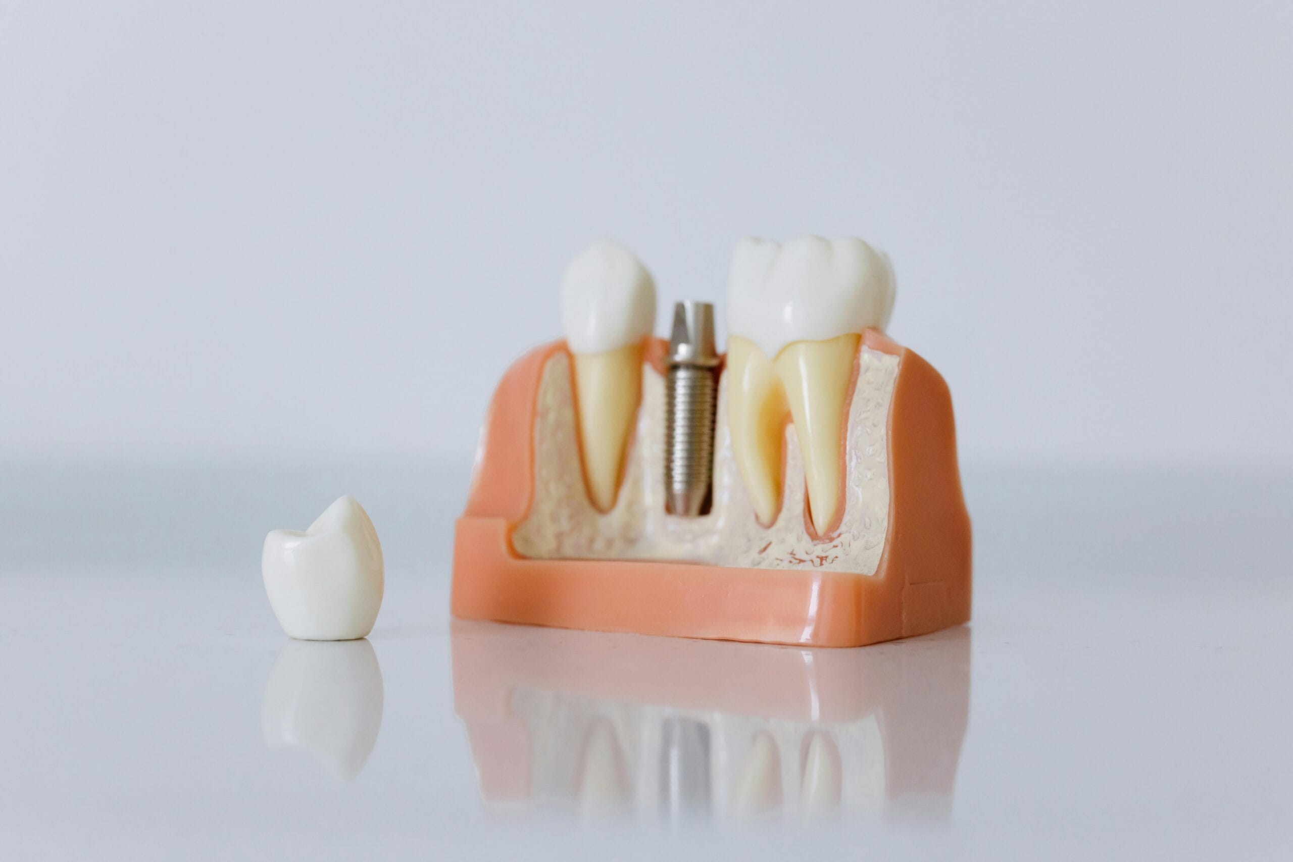Dental Implants at bespoke dental Fulham