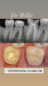 Before and After photos P.C.