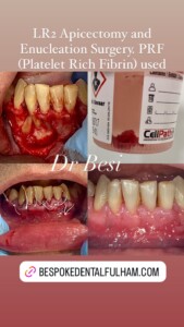 Surgery EB