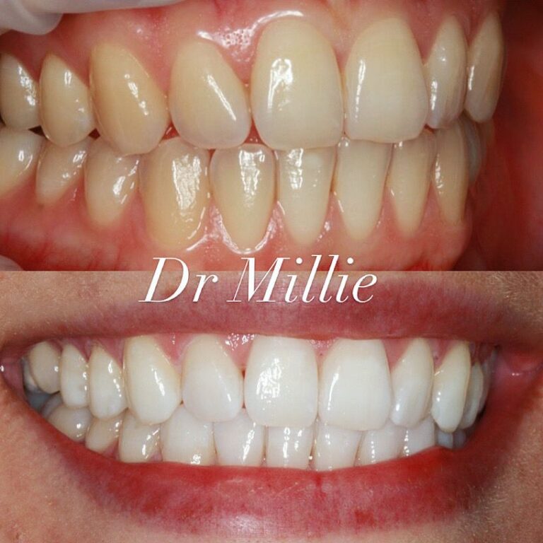 Teeth Whitening Before and After Bespoke Dental Fulham