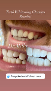 Teeth Whitening Before and After Bespoke Dental Fulham 2