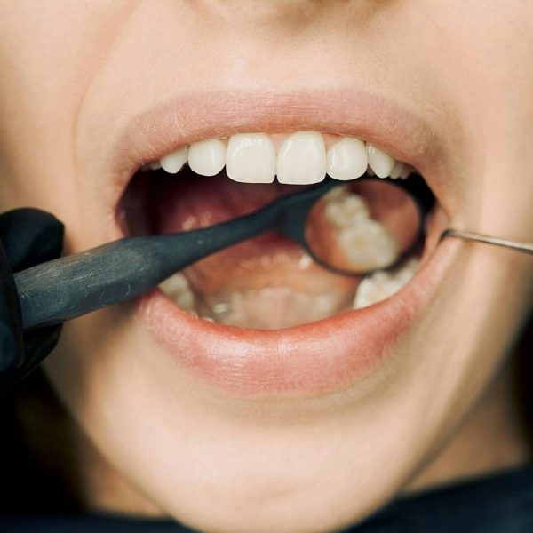 what is a root canal?